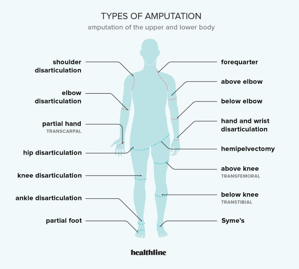 Types-of-Amputation